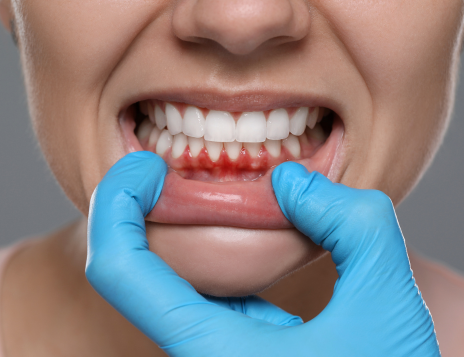 How to Recognise and Prevent Gum Disease